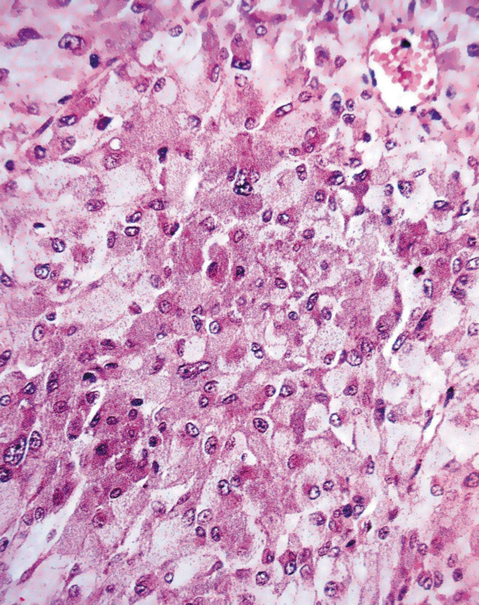 E-Fig. 17.6, Phaeochromocytoma (HP)