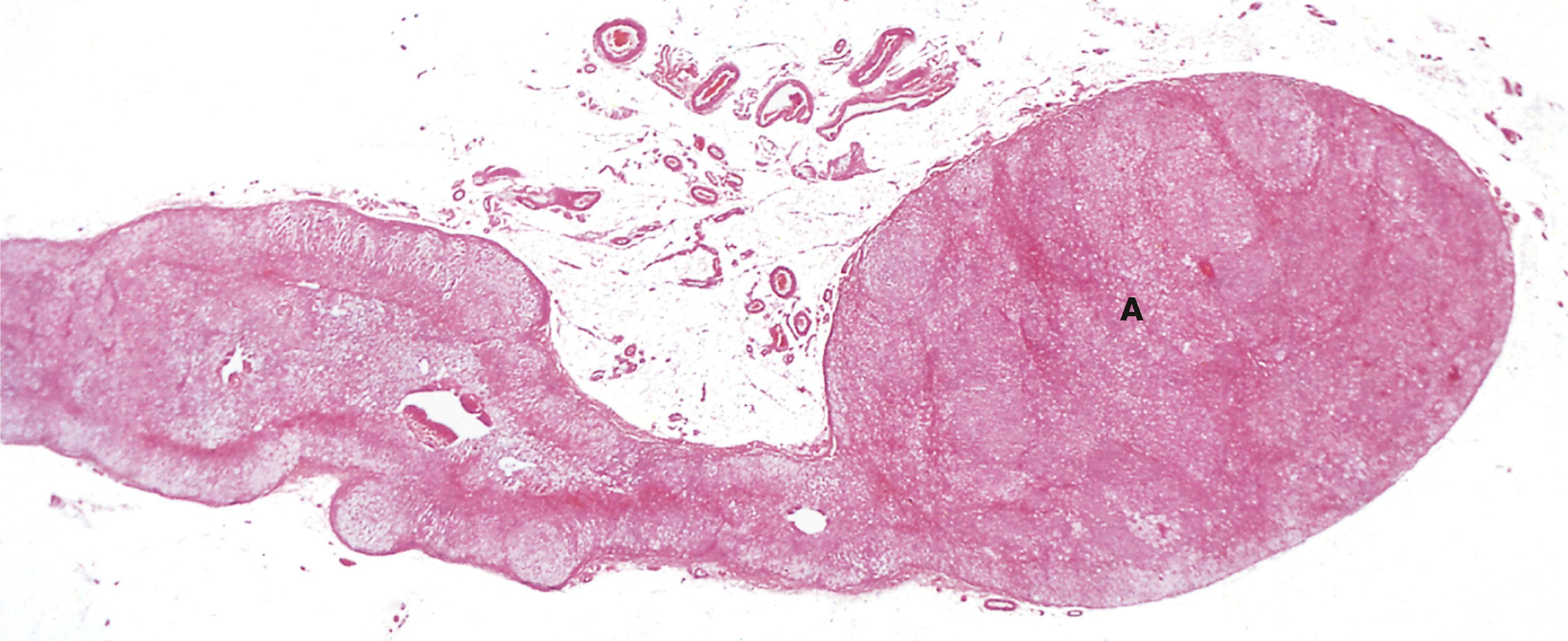 E-Fig. 17.8, Adrenal cortical adenoma (LP)