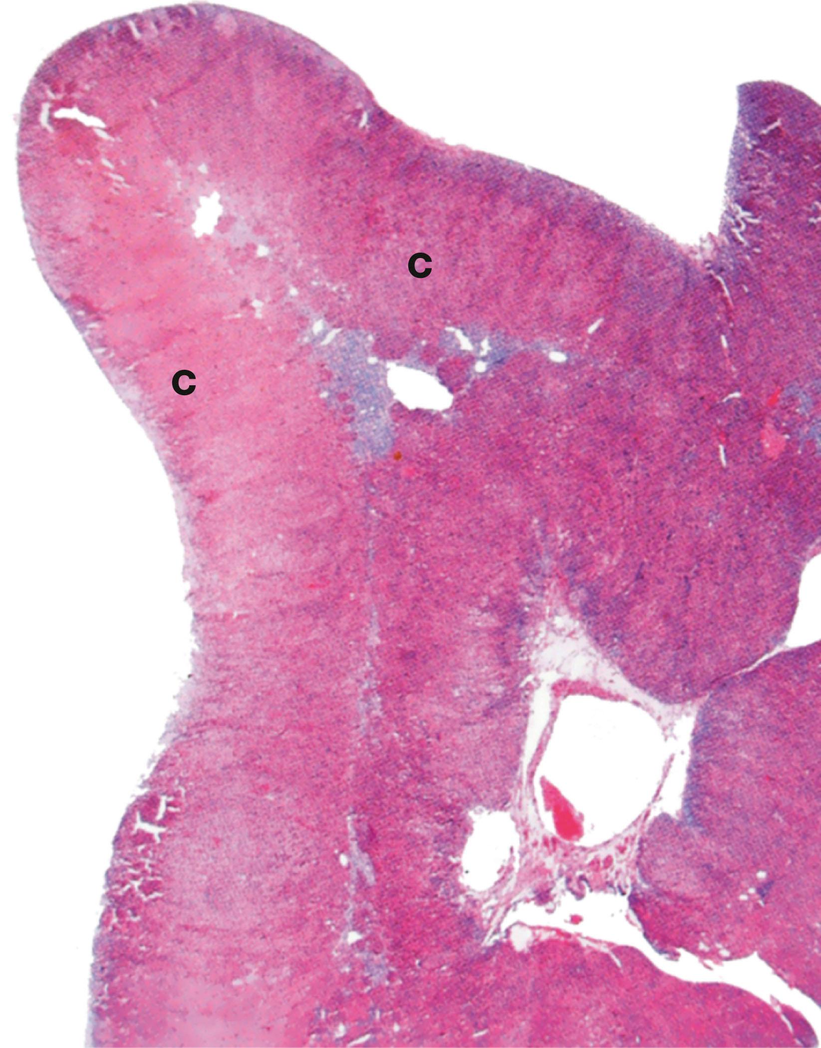 E-Fig. 17.9, Diffuse hyperplasia (LP)