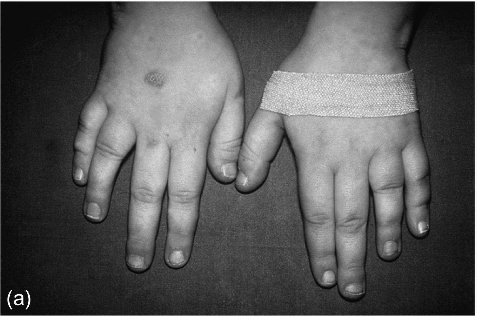 Fig. 6.1, Short fourth and fifth metatarsals of a child ( A ), which are more readily appreciated on the radiograph ( B ).