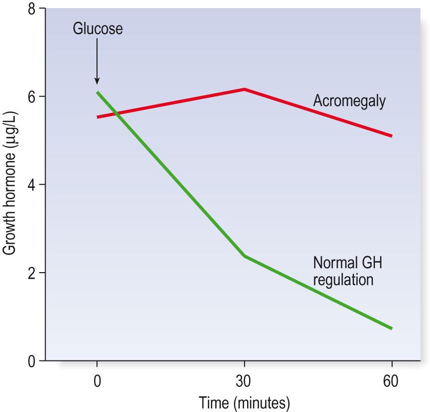 Fig. 10.8, Glucose suppression of growth hormone (GH) secretion in a normal person and failure of suppression in a person with acromegaly.