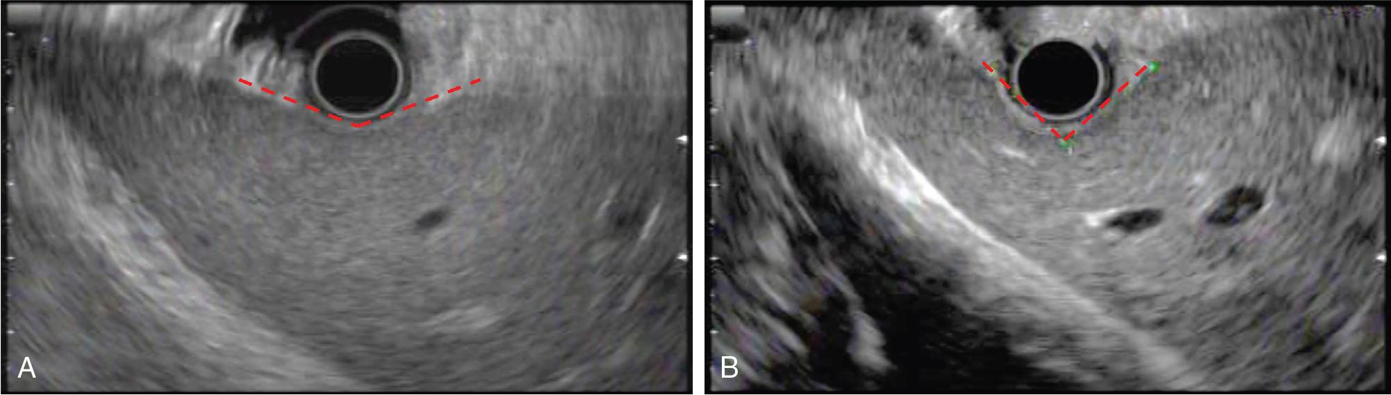 • Fig. 28.1, Liver palpation with echoendoscope (A) EUS transducer flat against liver surface “prepalpation” (B) EUS transducer indenting liver surface in normal liver during “palpation.”