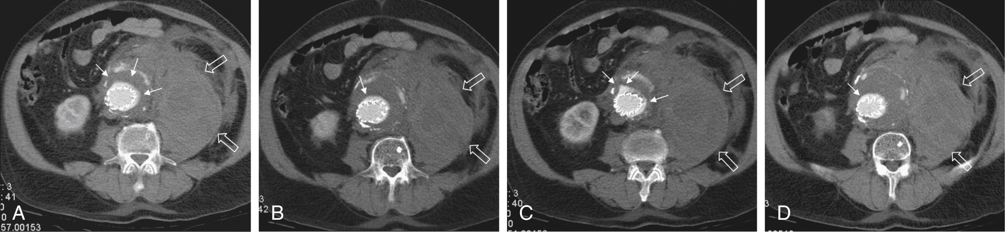 Fig. 23.1, (A)–(D) Axial computed tomography slices show a proximal type I endoleak (EL) ( small arrows ) that resulted in aneurysm rupture. Retroperitoneal hematoma can be seen clearly ( open arrows ).