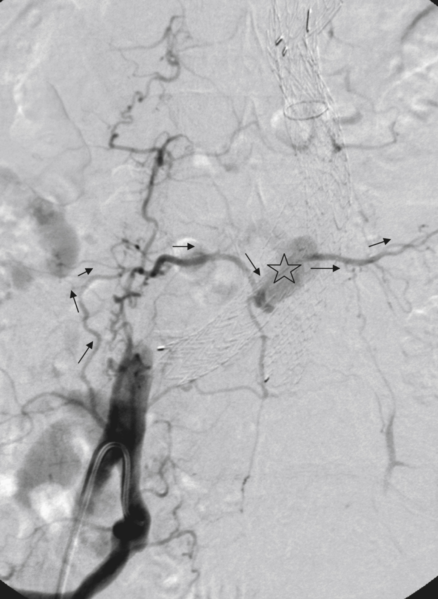 Fig. 23.2, Angiography 18 months after endovascular repair shows a typical type II endoleak (EL) being fed by right iliolumbar artery. This artery communicates with right lumbar artery at the L5 level. Lumbar artery is perfused in a retrograde fashion ( arrows ). In contrast, left lumbar artery showed antegrade flow ( arrows ). An inflow/outflow situation thus occurs, the typical feature of a type II EL. EL itself is marked with a star .