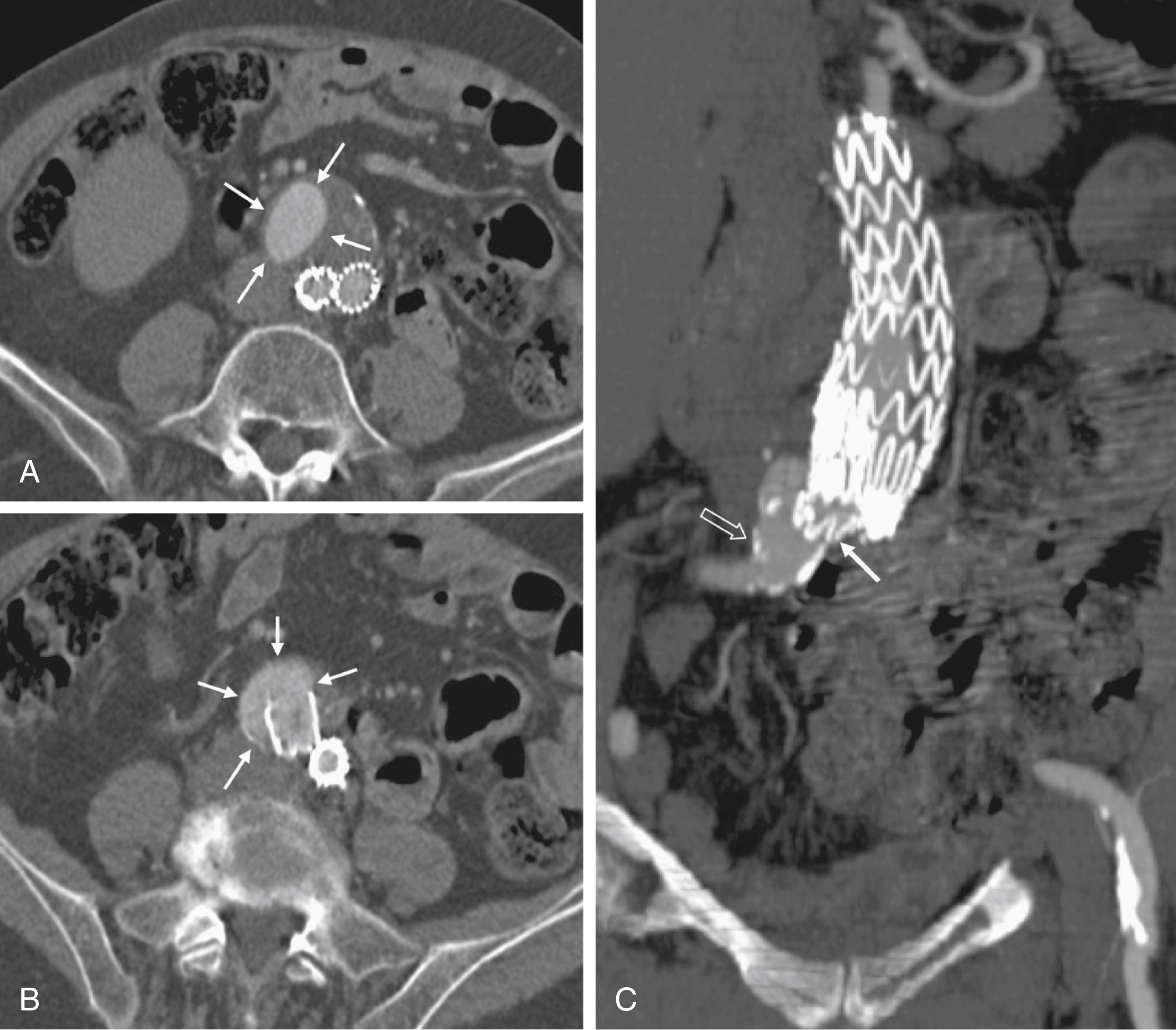 Fig. 23.3, (A)–(C) Computed tomographic angiography follow-up 12 months after endovascular repair. Slippage of the right iliac limb out of the short right common iliac artery has resulted in a distal type III endoleak ( white arrows ). Multiplanar reconstruction ([C]) nicely shows relationship of dislocated iliac limb ( solid arrow ) to parent vessel ( open arrow ).