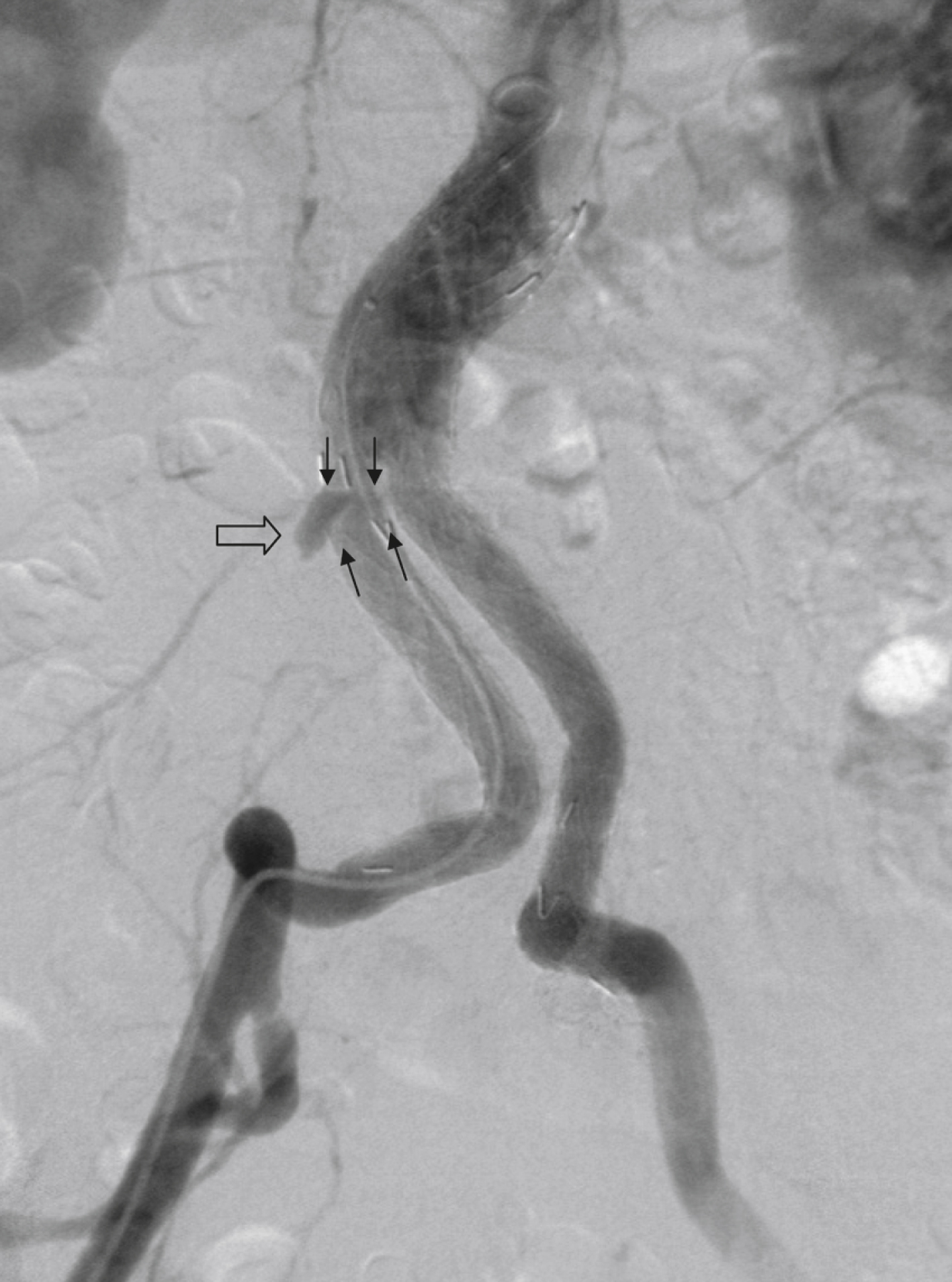 Fig. 23.4, Angiographic follow-up 18 months after endovascular repair with a first-generation stent-graft. Right iliac limb has separated from stent-graft body ( black arrows ). A type III endoleak is the consequence ( open arrow ).