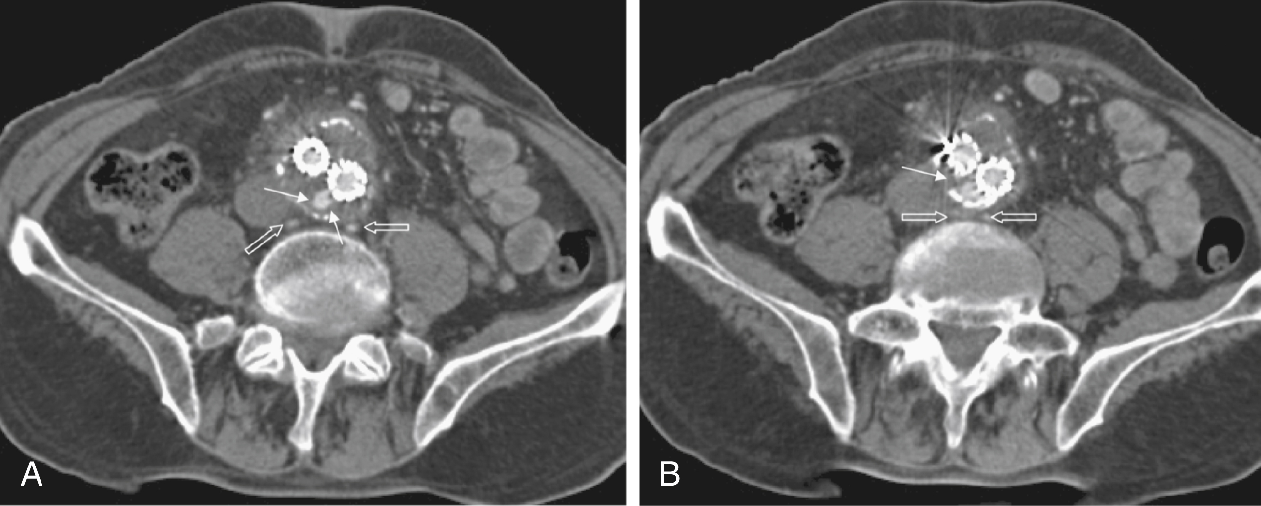 Fig. 23.6, Axial computed tomography (CT) slices ( [A] and [B]) show a type II endoleak ( small white arrows ). Note that lumbar arteries of segment L5 are well perfused and therefore permit an inflow/outflow situation ( open arrows ). However, CT is unable to show the direction of flow.