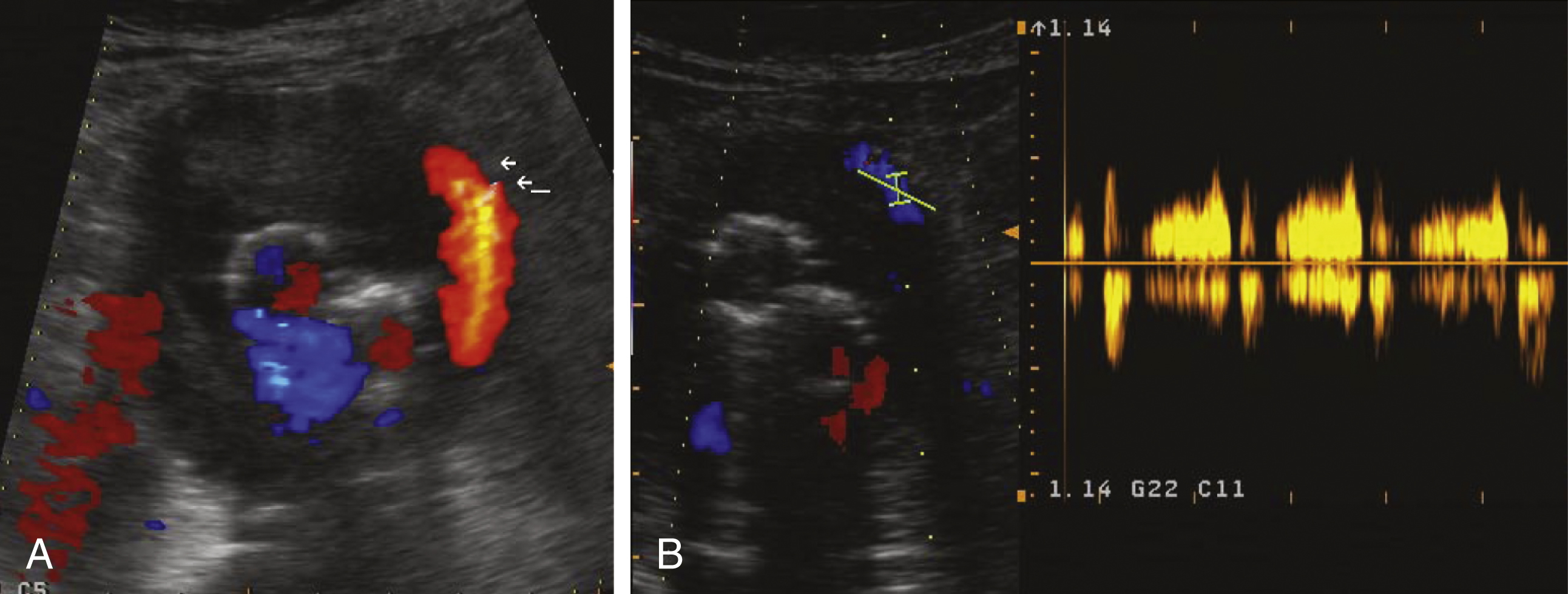 Fig. 23.7, (A) Color-coded ultrasound. Transverse image shows a large communicating type II endoleak (EL) ( arrows ) perfused via fourth lumbar arteries and inferior mesenteric artery. (B) Spectral Doppler ultrasound shows pulsatile flow in EL.