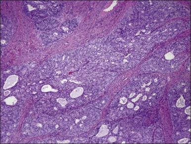 Figure 18.11, Endometrial adenocarcinoma, endometrioid type. Poorly differentiated (grade 3) tumor.