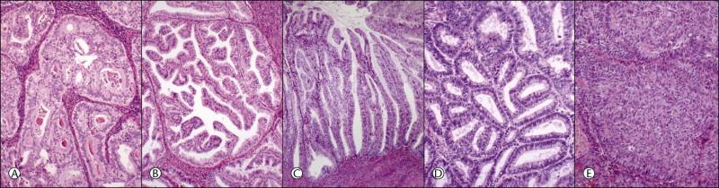 Figure 18.12, (A–E) Intraendometrial adenocarcinoma. Glandular architectural patterns that may be seen in non-myoinvasive areas. (A) Cribriform glands; (B) Maze-like or meandering lumens; (C) Villoglandular; (D) Confluent polygonal molded glands; (E) Solid growth.