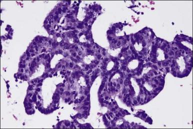 Figure 18.13, Endometrial adenocarcinoma, endometrioid type, with microglandular cribriform architecture. These delicate lesions tend to be exophytic, and may appear highly fragmented in biopsy specimens.