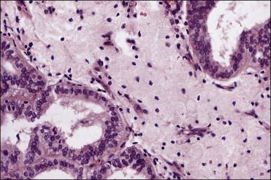 Figure 18.14, Endometrial adenocarcinoma. Foam cells in the stroma.