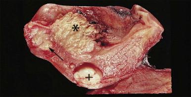 Figure 18.6, Endometrial adenocarcinoma. A section through the wall of a uterus shows carcinoma protruding into the lumen (*) and invading deeply into the myometrium (black arrow). A leiomyoma is also present (+).