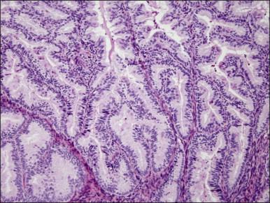 Figure 18.7, Endometrial adenocarcinoma, endometrioid type, grade 1 (well differentiated). The branching glands with maze-like lumens indicate an architecture of folded sheets of neoplastic epithelium, rather than dense packing of tubular structures.