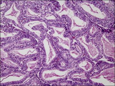 Figure 18.8, Endometrial adenocarcinoma, endometrioid type. Well-differentiated (grade 1) tumor with confluent glands.