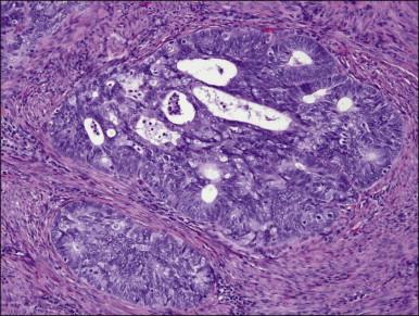 Figure 18.10, Endometrial adenocarcinoma, endometrioid type. Moderately differentiated (grade 2) tumor, with solid and cribriform areas.