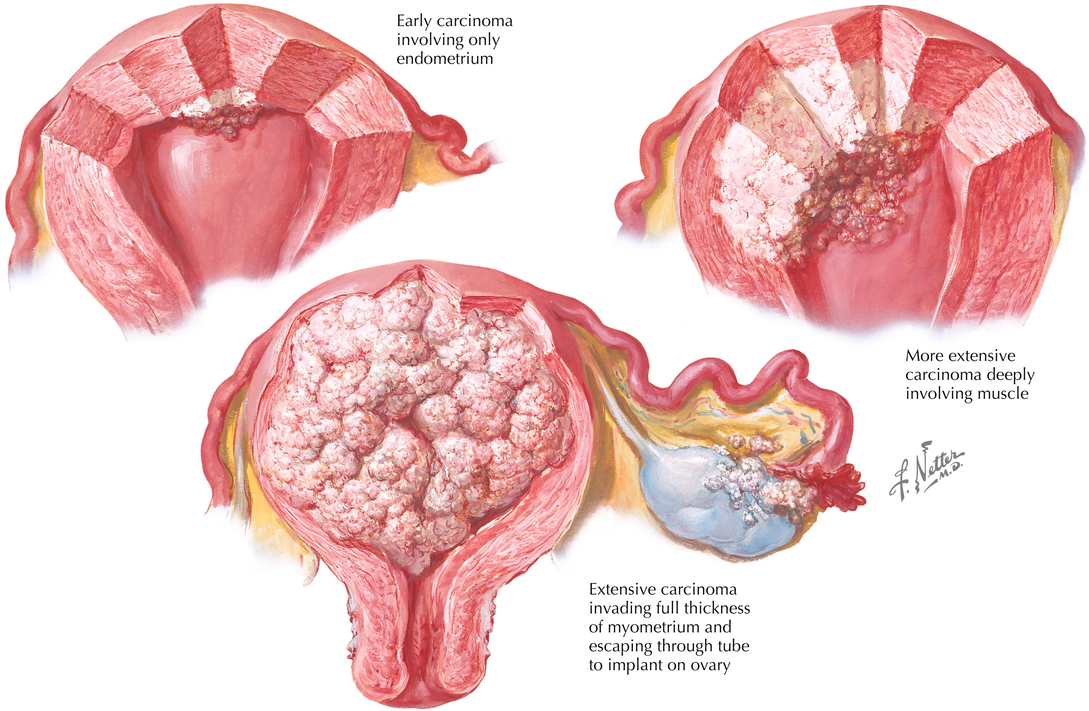 Figure 133.1, Uterine endometrial carcinoma stages and types