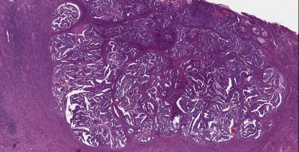 FIG. 10.11, Endometrial carcinoma with expansile (pushing) myometrial invasion. The smooth outer contour may simulate adenomyosis involvement. However, the tumor extends beyond the confines of the endo-myometrial junction and there are significant amounts of smooth muscle in between clusters of neoplastic glands exceeding the distribution expected in adenomyosis.