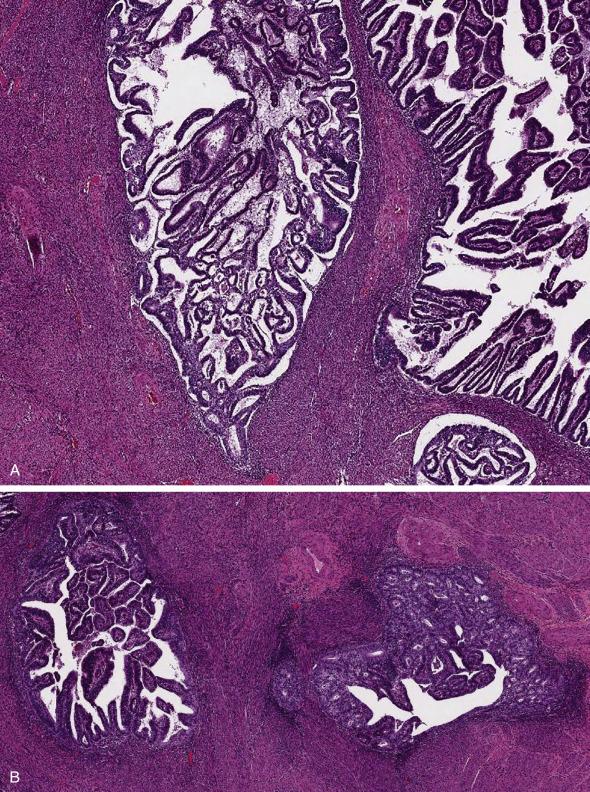 FIG. 10.12, Endometrial carcinoma with extension into adenomyosis. Areas of carcinoma have smooth, convex contours and the neoplasm does not haphazardly “entrap” smooth muscle (A). Residual normal glands or stroma can be appreciated (B).