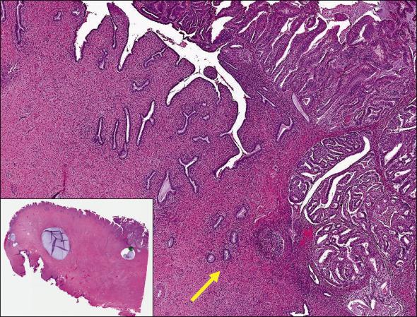 FIG. 10.14, Endometrial carcinoma with cervical stromal involvement. The most upper endocervical mucinous gland is considered the boundary between the cervix and the lower uterine segment (arrow) . The absence of serosa in the outer aspect of the wall and the distal location, better seen at scanning view, is a supporting feature (inset) .