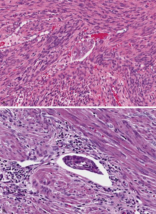 FIG. 10.15, True lymphovascular space invasion by endometrial carcinoma. Notice the shape of the tumor cluster conforming to the shape of the vessel and eosinophilic cytoplasmic change (A), and the perivascular inflammatory infiltrate (B).