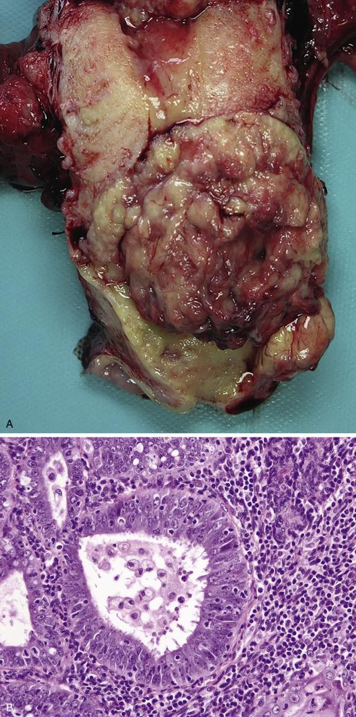 FIG. 10.17, (A) Gross, morphologic and immunohistochemical features associated with Lynch syndrome. A bulky polypoid tumor primarily involves the lower uterine segment. (A, Courtesy Joseph Carlson, Karolinska Institute.) A striking intratumoral and peritumoral lymphocytic infiltrate is present (B). The tumor cells show loss of MSH6, which is uncommon but highly correlated with Lynch syndrome (C). (D) Algorithm for genetic testing in carcinomas with abnormal immunohistochemical expression of MMR proteins. (D, Based on algorithm by RA Soslow, Mod Pathol . 2016;29:559 -577).