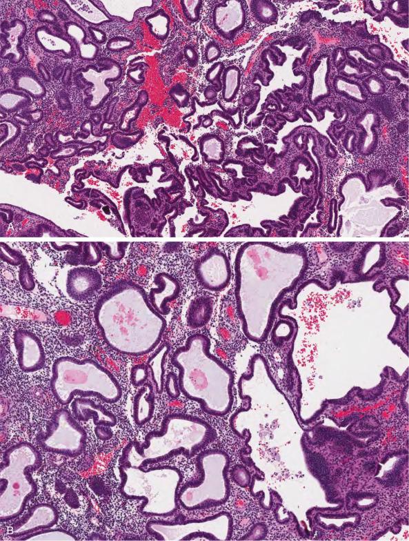 FIG. 10.2, Nonatypical endometrial hyperplasia. There is an increase in the number of endometrial glands, with surface area exceeding that of the surrounding stroma (A). Glands are irregular and often cystically dilated (B). The glands show cytologic features similar to those seen in proliferative endometrium (C). Some cases feature increased architectural complexity (D).