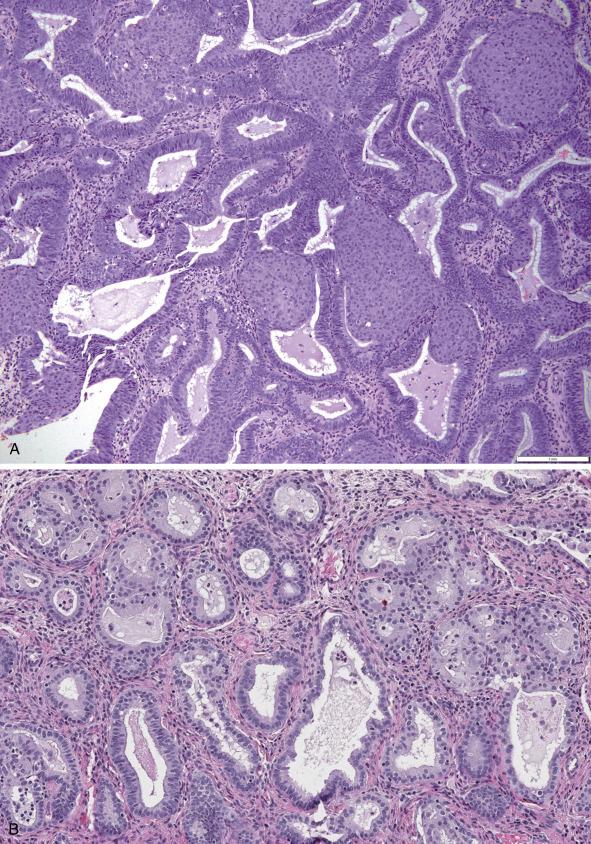 FIG. 10.4, Atypical endometrial hyperplasia/endometrioid intraepithelial neoplasia with variant differentiation. Spectrum of metaplasias includes squamous morular (A), mucinous (B), secretory (C), and papillary (D, also notice mucinous differentiation).