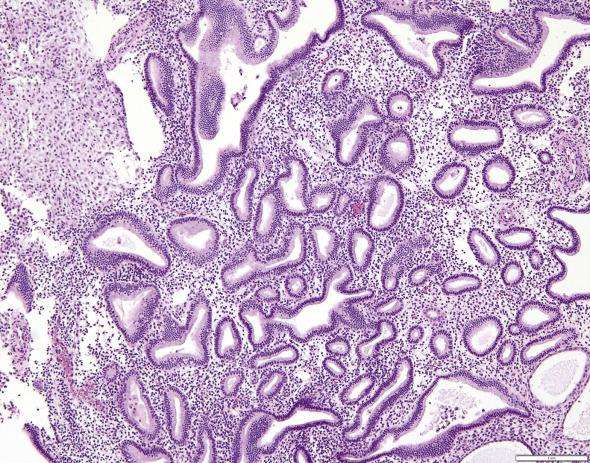 FIG. 10.5, Atypical endometrial hyperplasia/endometrioid intraepithelial neoplasia treated with progestins. Notice the background pseudodecidualized stroma, absence of conventional epithelial “atypia,” and the rather bland nuclear features. Glandular crowding, however, persists.