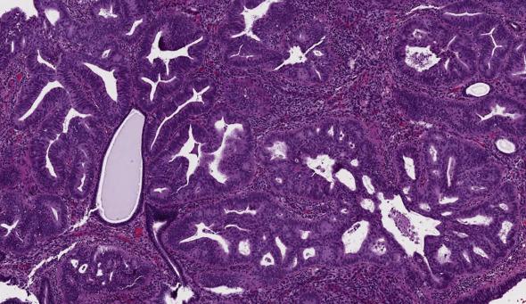 FIG. 10.7, At least atypical endometrial hyperplasia/endometrioid intraepithelial neoplasia. While stroma can still be appreciated around most of the neoplastic glands, there is focal cribriform architecture and confluence bordering on early well-differentiated carcinoma.