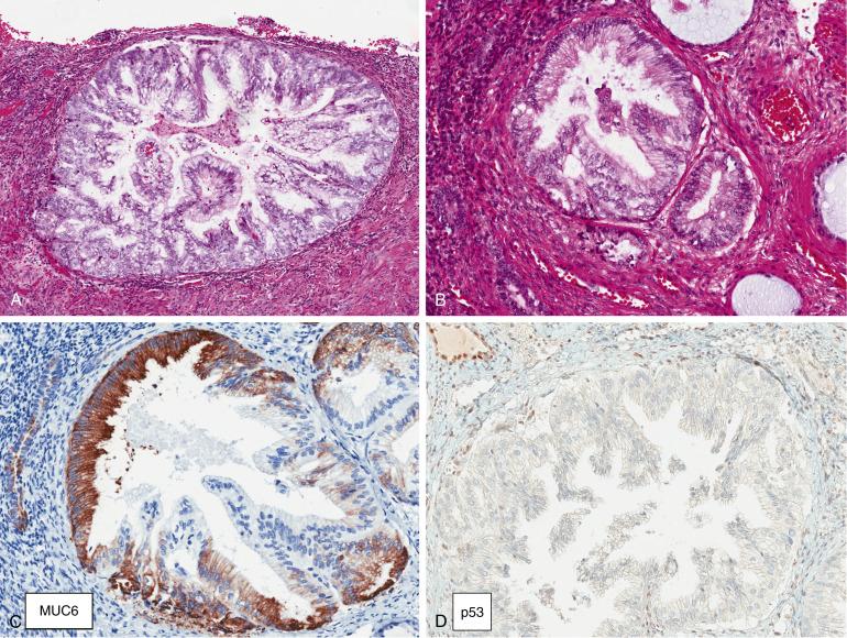 FIG. 10.8, Gastric-type endocervical adenocarcinoma (A) with proximal spread and involvement of the endometrium, mimicking endometrial intraepithelial neoplasia (B). Notice the mucinous differentiation of the abnormal glands and the significant nuclear atypia. Positivity for MUC6, a gastric marker (C), and abnormal p53 expression (D, complete absence) are inconsistent with endometrioid intraepithelial neoplasia, and more in keeping with gastric-type endocervical neoplasia in this context.