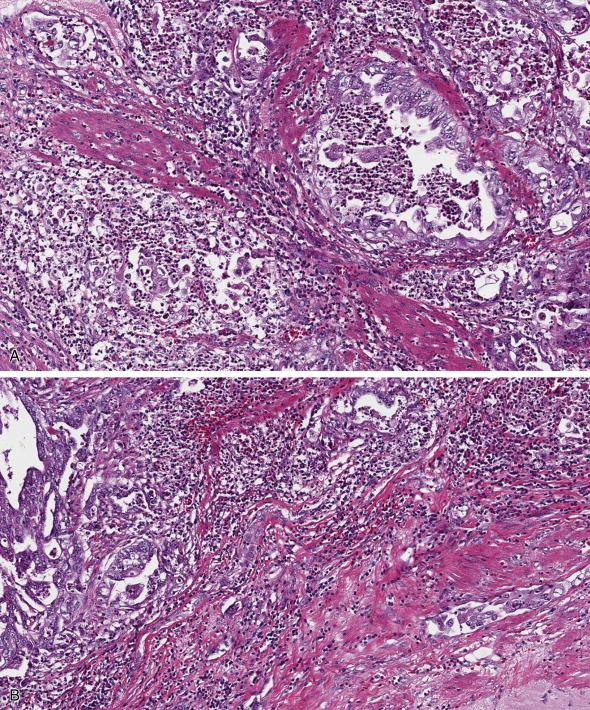 FIG. 10.10, Endometrial endometrioid carcinoma with a microcystic, elongated, and fragmented (MELF) pattern of invasion. MELF pattern shows glands with microcystic change, elongation, and fragmentation, associated with a heavily inflamed stroma (A). Some glands have attenuated epithelium or appear effaced by the dense inflammatory infiltrate (B).