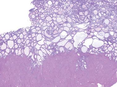 Fig. 8.1, Non-atypical (simple-cystic) hyperplasia. Most of the glands are dilated. On high power there was no cytologic atypia.