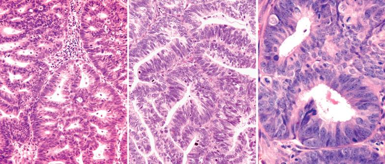 Fig. 8.11, Endometrioid adenocarcinoma, FIGO grade 1. Left: Cribriform pattern. Center: Prominent cellular stratification. Right: Overt malignant nuclear features with several mitotic figures.