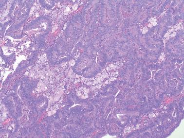 Fig. 8.12, Endometrioid adenocarcinoma, FIGO grade 1. Stromal foamy histiocytes are conspicuous, a frequent useful finding in cases of endometrioid neoplasia.