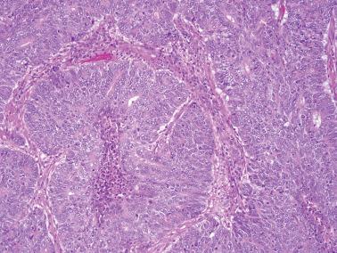 Fig. 8.13, Endometrioid adenocarcinoma, FIGO grade 2. There is a focal solid growth of neoplastic cells without evidence of squamous differentiation.