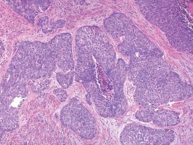 Fig. 8.14, Endometrioid adenocarcinoma, FIGO grade 3.