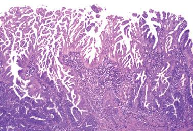 Fig. 8.15, Endometrioid adenocarcinoma, FIGO grade 1. The surface of the tumor shows a striking filiform pattern, which is reminiscent of syncytial papillary change but is an alteration of neoplastic cells. Note the typical endometrioid carcinoma at the bottom.