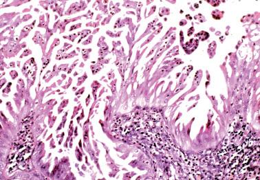 Fig. 8.16, Endometrioid adenocarcinoma, FIGO grade 1. A higher-power view of the surface change seen in the prior figure showing very delicate thin papillae with occasional inflammatory cells.