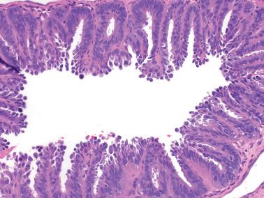 Fig. 8.17, Endometrioid adenocarcinoma, FIGO grade 1. There is sloughing of superficial cells, some suggesting a hobnail appearance and thus potentially mimicking clear cell or serous carcinoma.