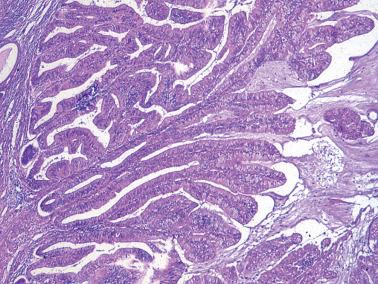 Fig. 8.18, Endometrioid adenocarcinoma. There is a transition from typical endometrioid epithelial cells (left) to columnar mucinous cells (right). Note the copious luminal mucin (right).