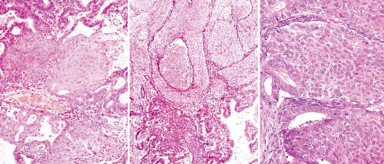 Fig. 8.19, Endometrioid adenocarcinomas with squamous (including morular) differentiation. Left: Metaplastic squamous epithelium within an otherwise typical grade 1 endometrioid adenocarcinoma. Center: Extensive squamous differentiation in which there is focal necrosis. Right: Bland morular cells completely or almost completely replace the gland lumina.