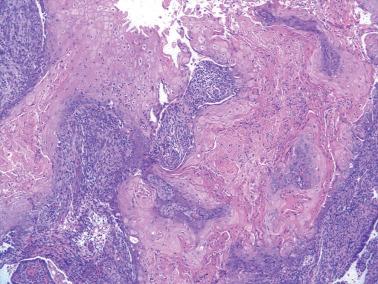 Fig. 8.20, Endometrioid adenocarcinoma, FIGO grade 1. Extensive mature squamous differentiation with keratin production can be seen in some tumors.