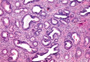 Fig. 8.2, Non-atypical (simple) hyperplasia. The crowded glands show slight irregularity in their shapes but had no cytologic atypia.