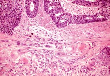 Fig. 8.21, Endometrioid adenocarcinoma with squamous differentiation, the latter showing the features of squamous cell carcinoma that appears to be independently invasive (‘adenosquamous carcinoma’).