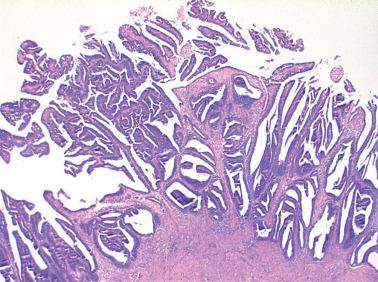 Fig. 8.22, Villoglandular endometrioid adenocarcinoma. The papillae are tall without the conspicuous budding that typifies serous carcinoma.