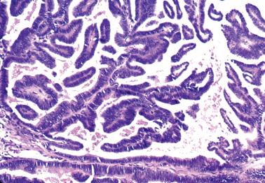 Fig. 8.23, Villoglandular endometrioid adenocarcinoma. An entirely villous area is depicted.