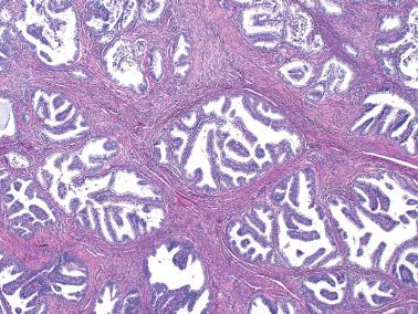 Fig. 8.24, Villoglandular endometrioid adenocarcinoma. Myoinvasive tumor shows retention of the villous pattern.