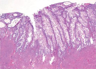 Fig. 8.25, Endometrioid adenocarcinoma with small nonvillous papillae. The small bud like papillae are architecturally reminiscent of serous carcinoma.