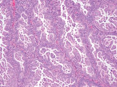 Fig. 8.26, Endometrioid adenocarcinoma with small nonvillous papillae. A high power view of the tumor in the prior figure shows low grade cytology in contrast to what one would expect in serous carcinoma.